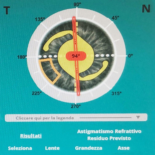 scaroni_immagine_cataratta_01_new