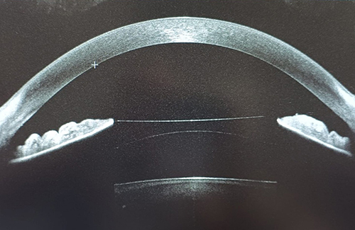 scaroni_immagine_chirurgia_refrattiva_01