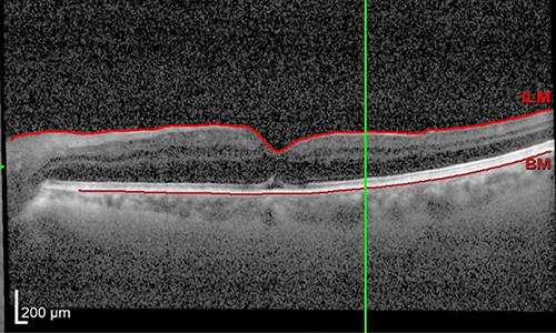 scaroni_immagine_foro_maculare_02