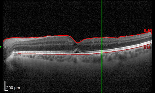 scaroni_immagine_foro_maculare_03