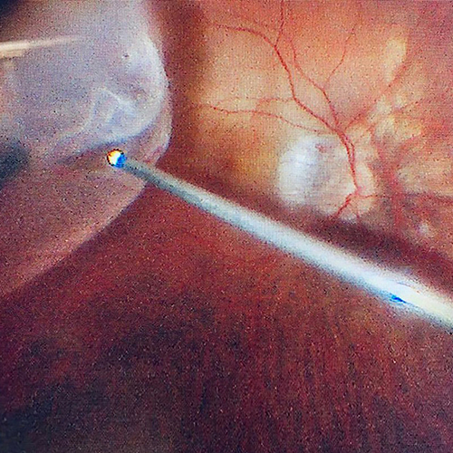 scaroni_immagine_vitreoretinica_02