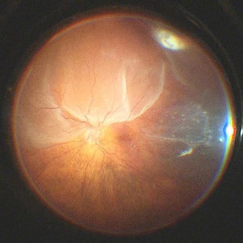 scaroni_immagine_vitreoretinica_03