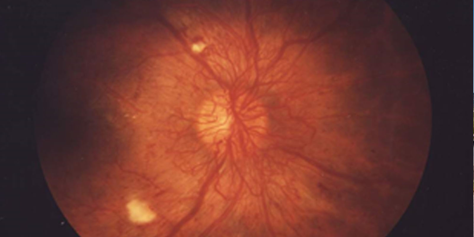 retinopatia brescia